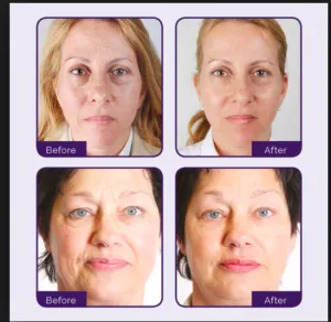 Meta Therapy by Dermatude before after