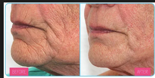 Meta Therapy by Dermatude 4