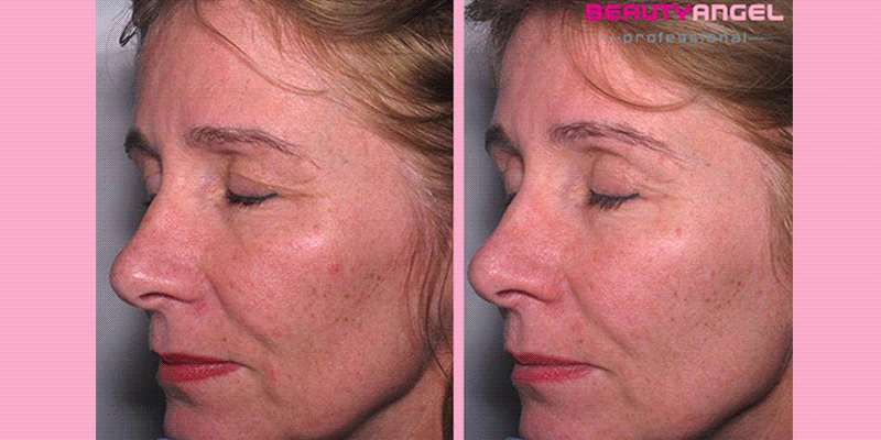 9 Reasons Why You Will Absolutely Collagen Light Therapy Aspa Direct