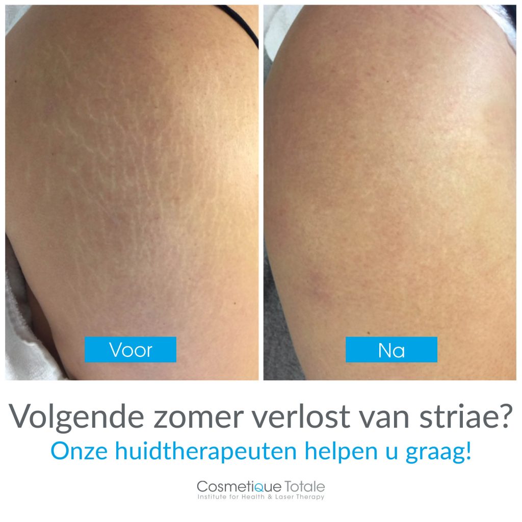 Striae