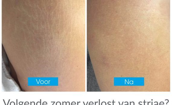 Striae