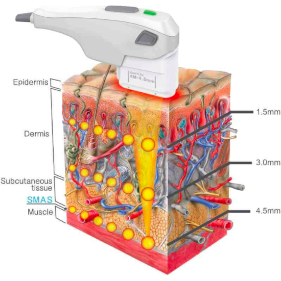 HIFU treatment