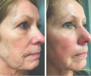 HOW TO IMPROVE YOUR SKIN AFTER SUN EXPOSURE?