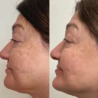 Heb je last van een ongelijkmatige huidskleur