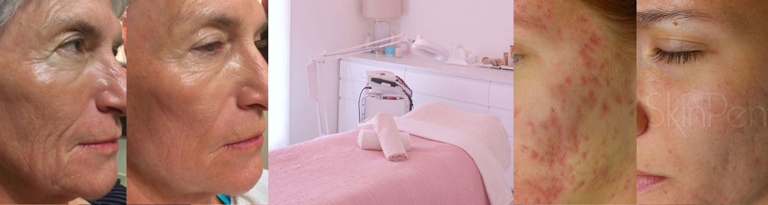 Microneedling-Den-Haag