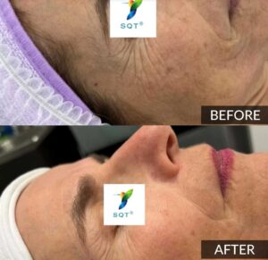 SQT Bio Microneedling before and after