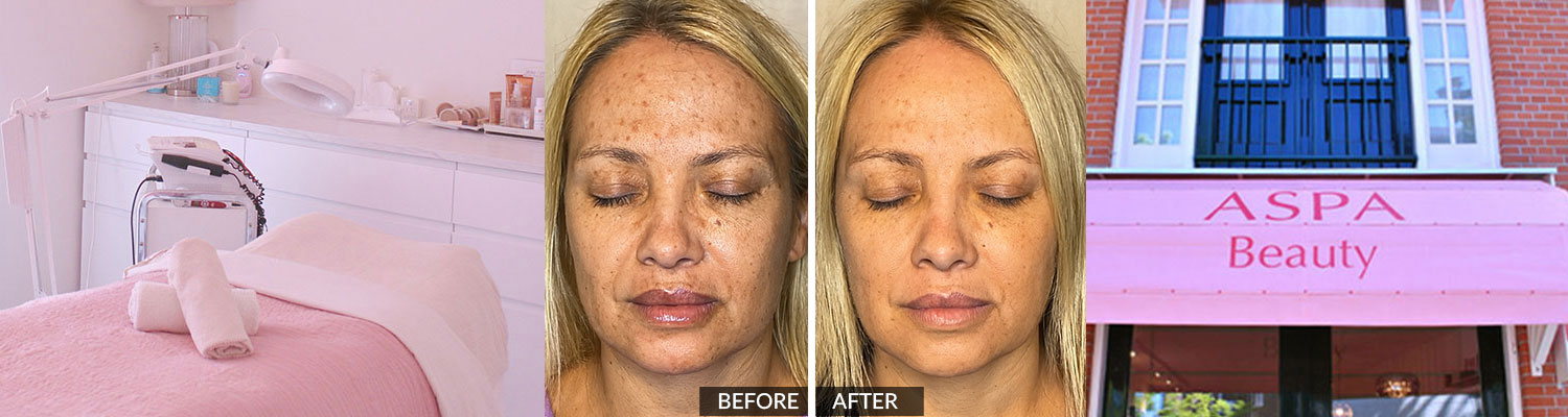 SQT-Bio-Microneedling--cover-nl