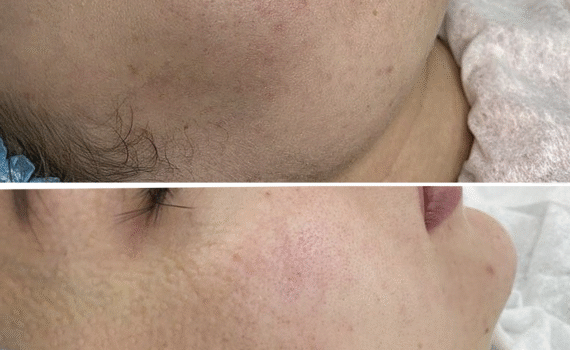 BioRePeel & Microneedling