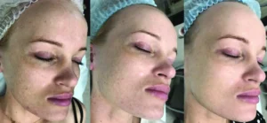 BioRePeel - TCA peeling