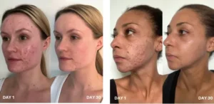 Deep Acne Skin Detox Behandeling