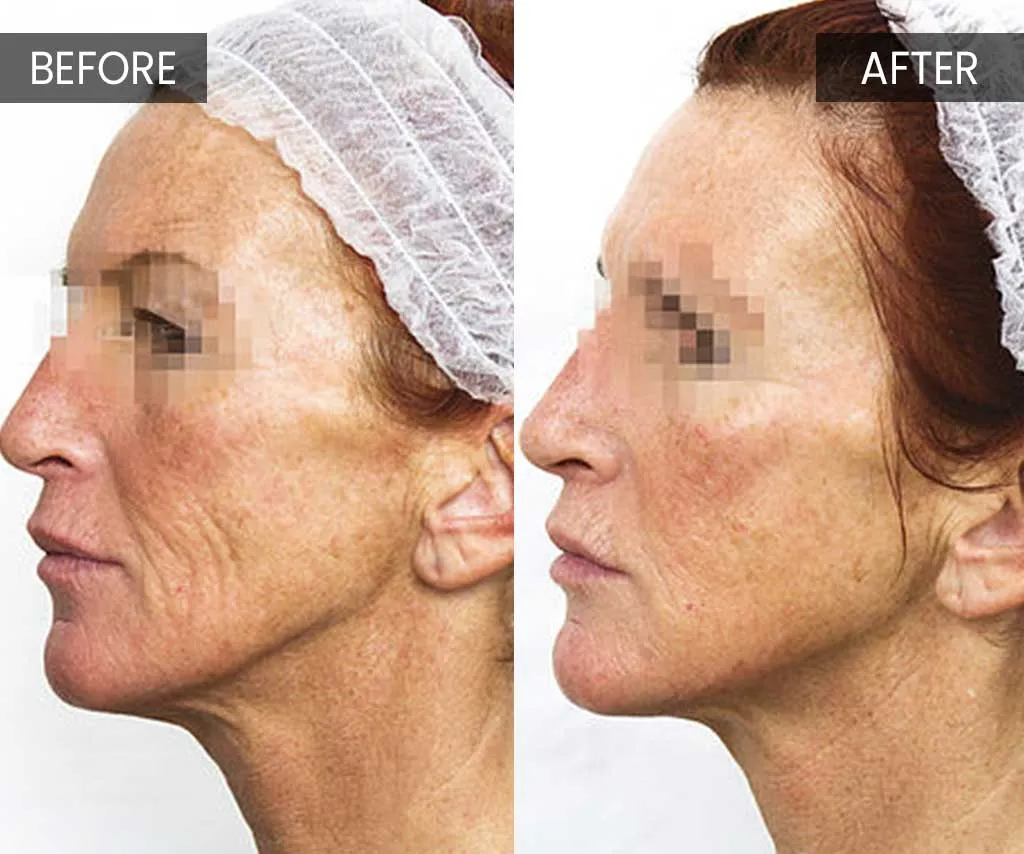 PRX-T33 Skin-Booster in Den Haag at ASPA