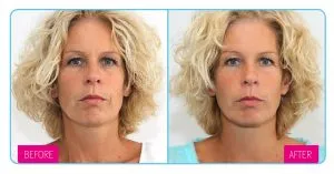 Dermatude Meta Therapy