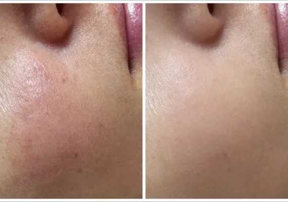 Understanding Rosacea + Facial Treatment Options