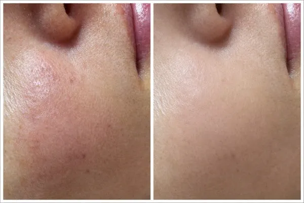 Understanding Rosacea + Facial Treatment Options