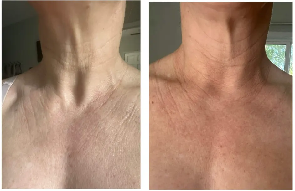 Do not forget your neck! Treatments, Nutrition & Strength Training Do not forget your neck! Treatments, Nutrition & Strength Training